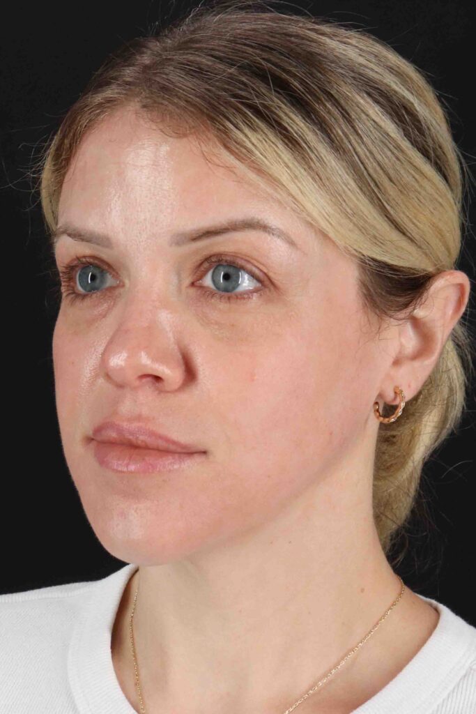 After - left_oblique