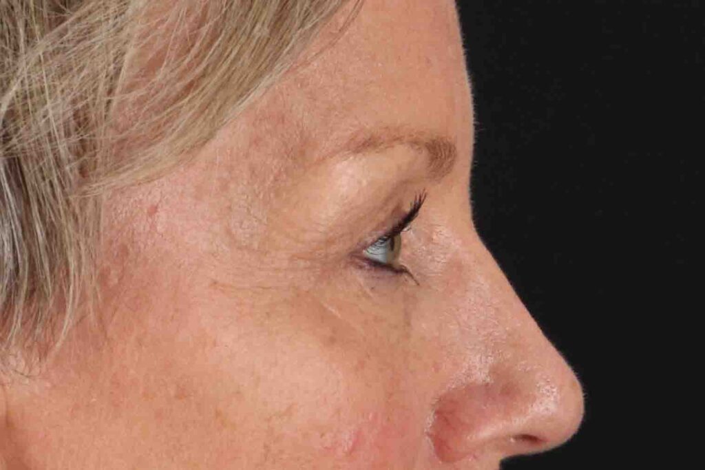 Before - right_lateral