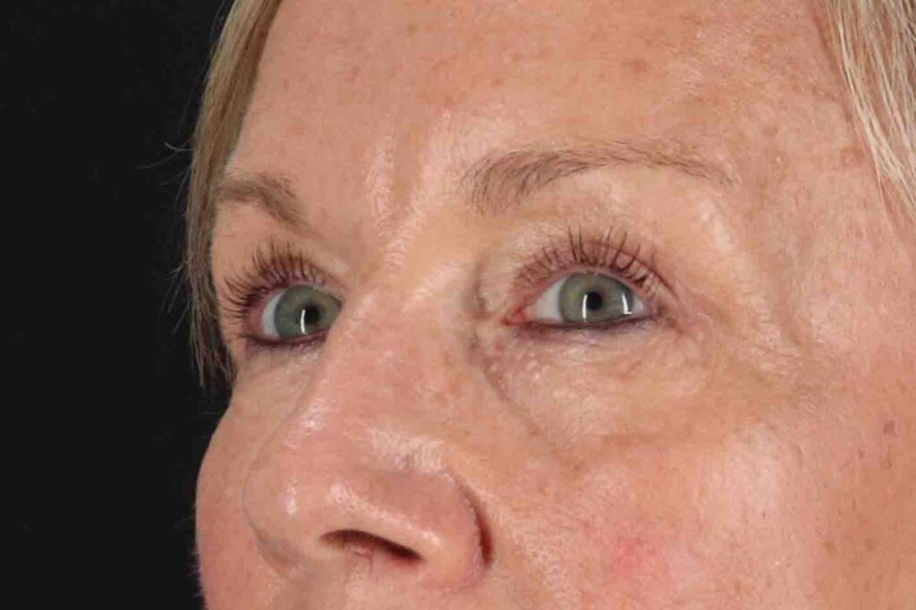 After - left_oblique