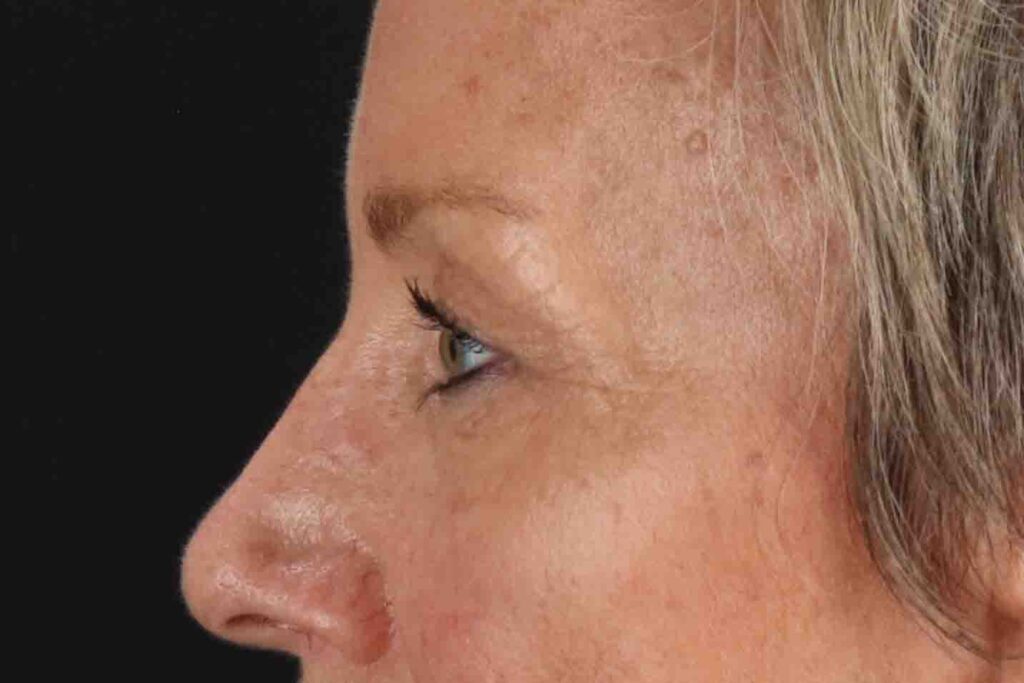 Before - left_lateral