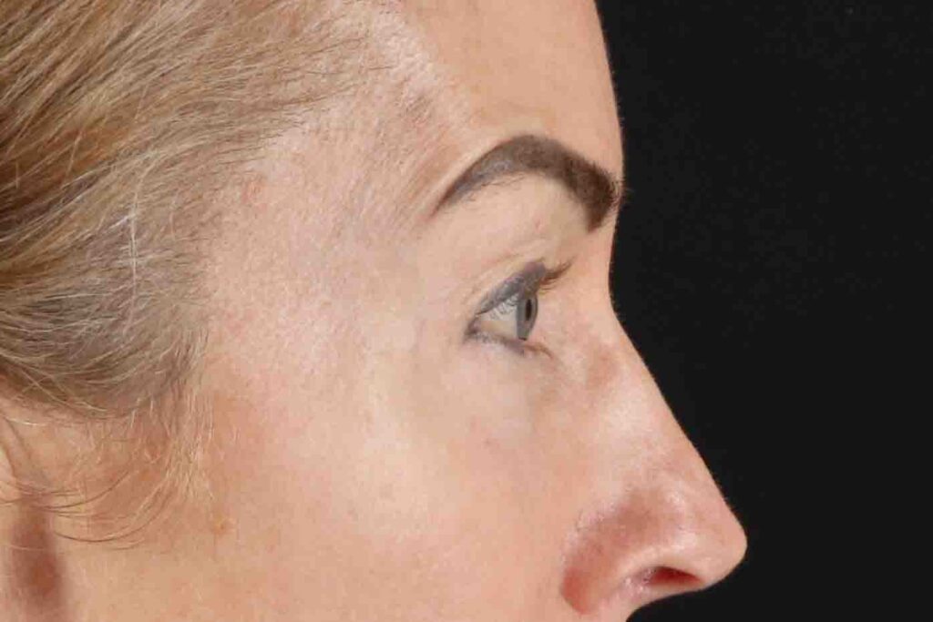 Before - right_lateral