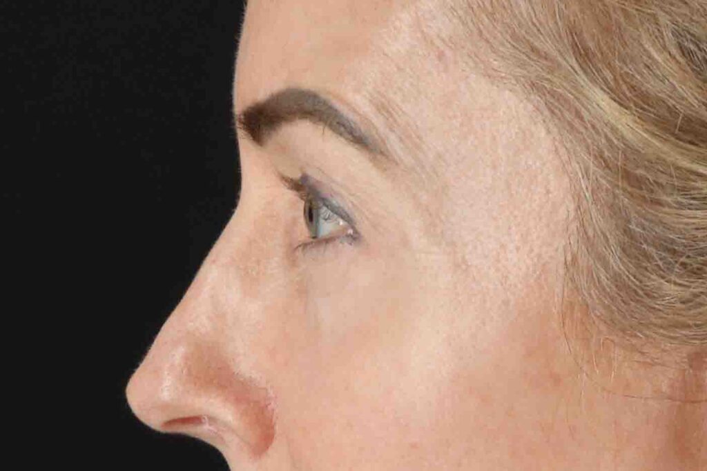 Before - left_lateral