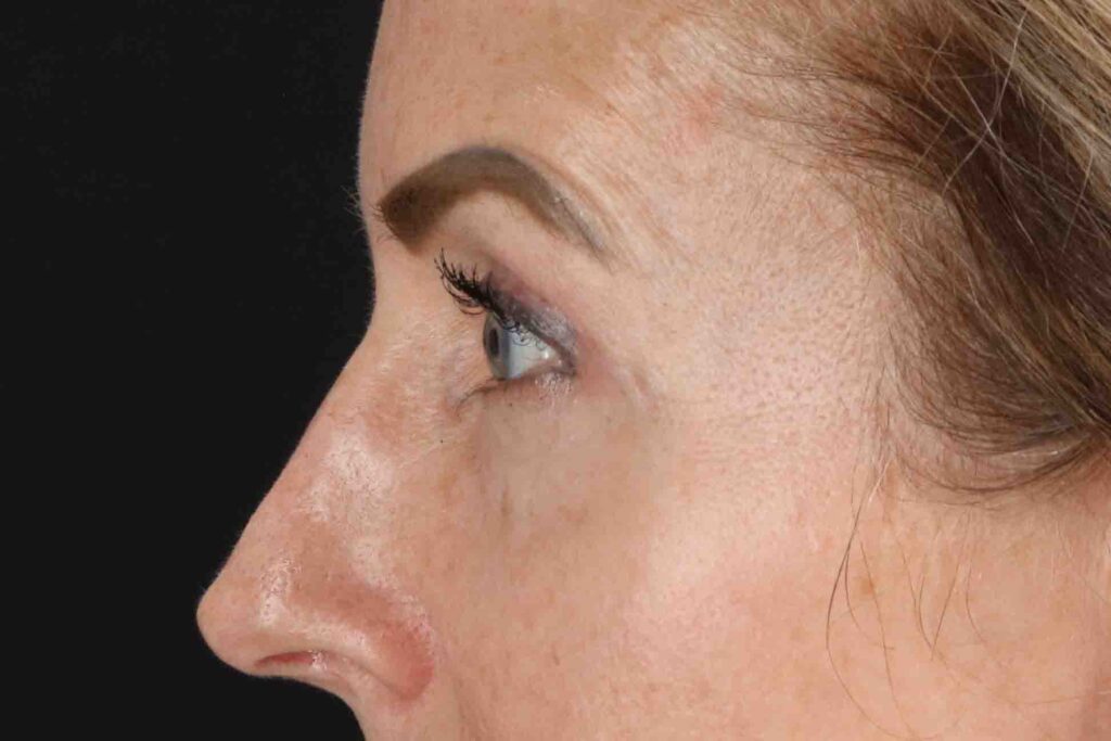 After - left_lateral