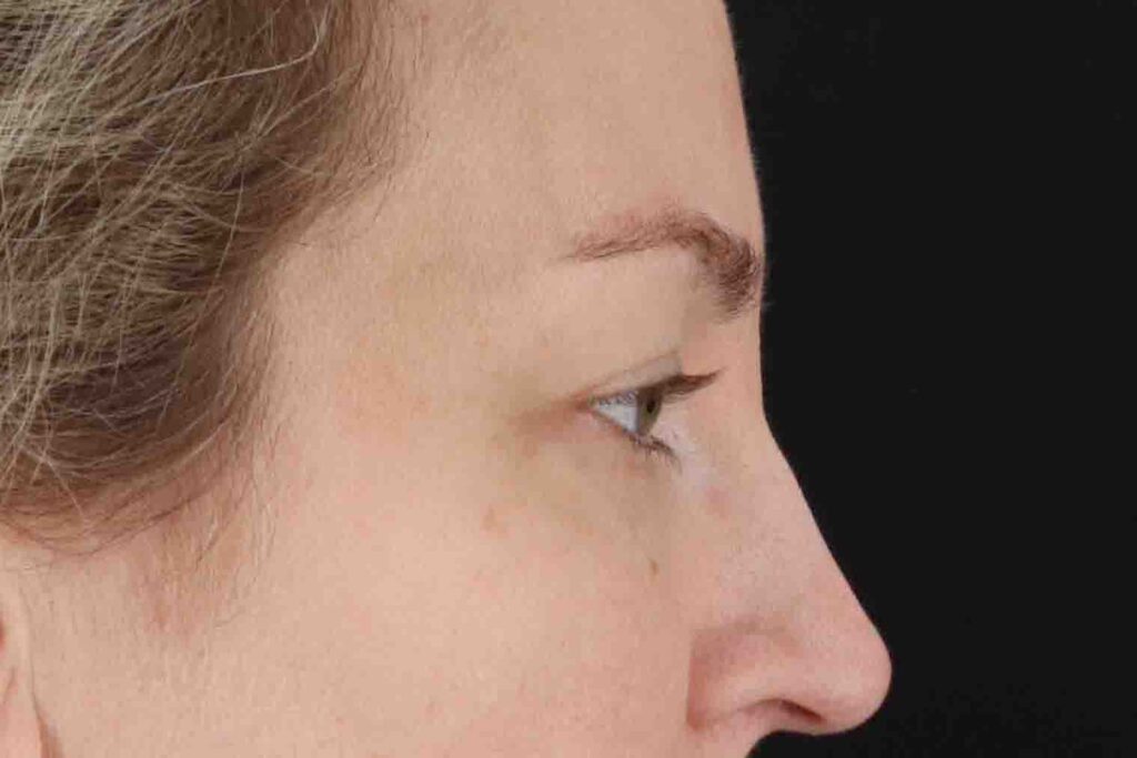 Before - right_lateral