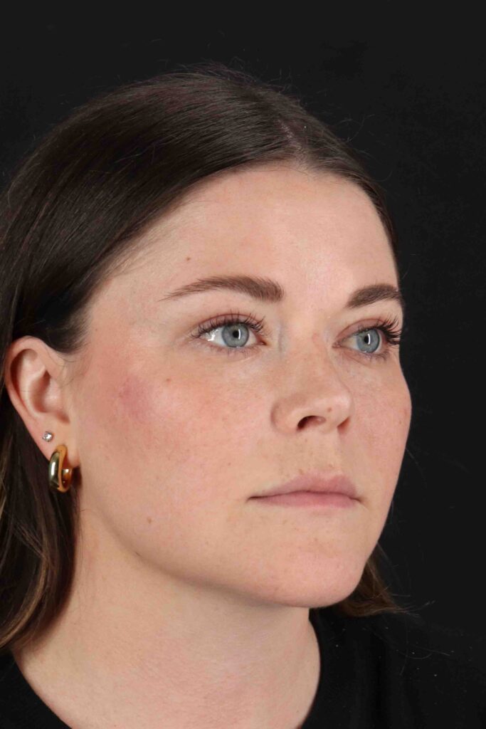 After - right_oblique