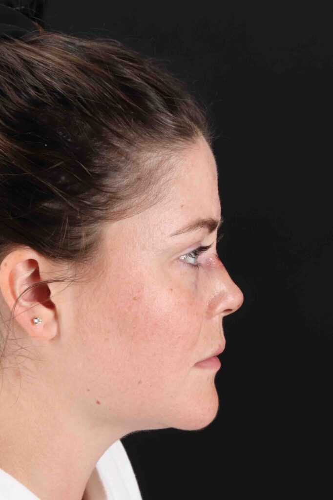 Before - right_lateral