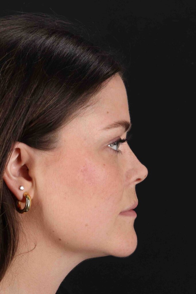 After - right_lateral