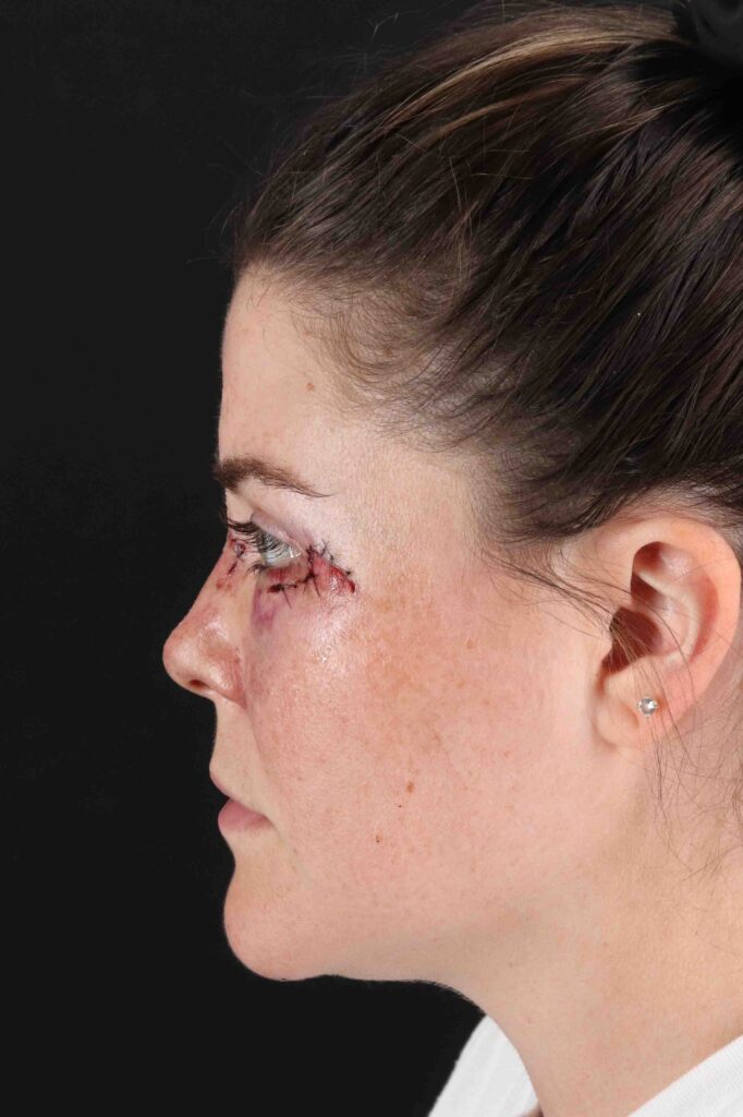 Before - left_lateral