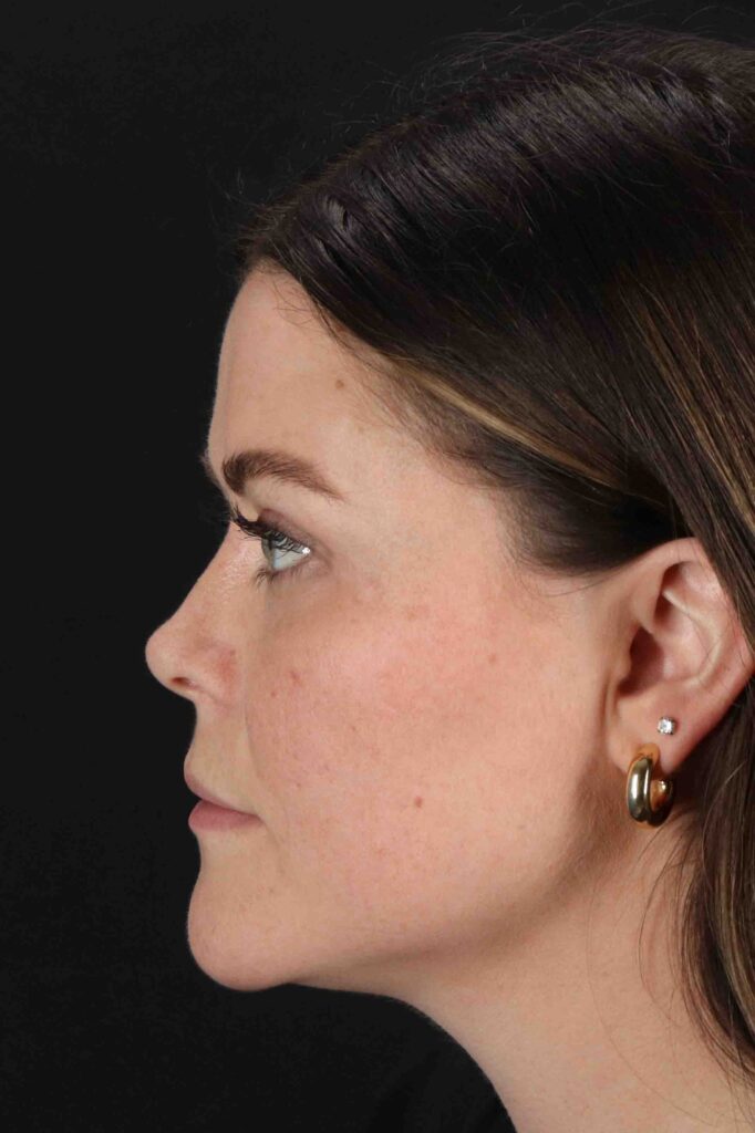 After - left_lateral