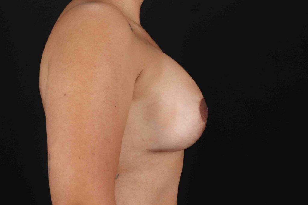 After - right_lateral