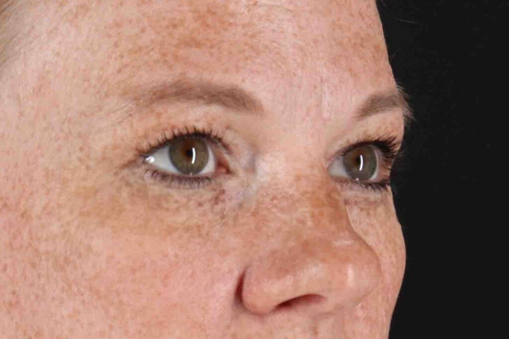 Before - right_oblique