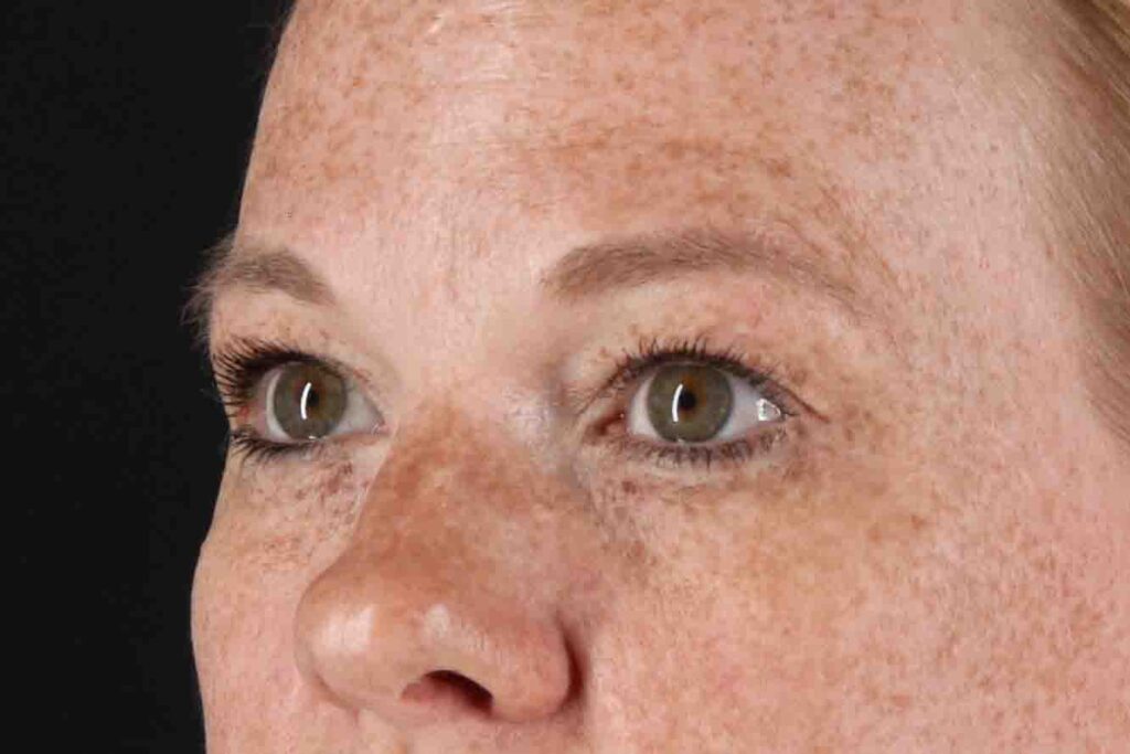 Before - left_oblique