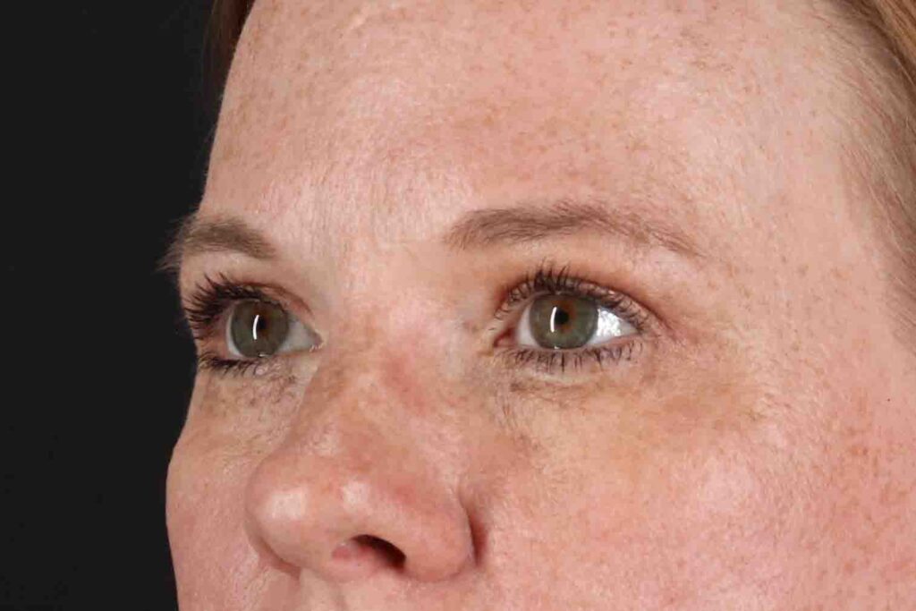 After - left_oblique