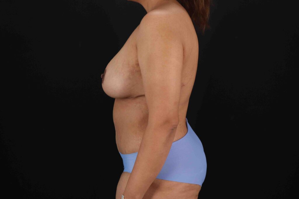 After - left_lateral