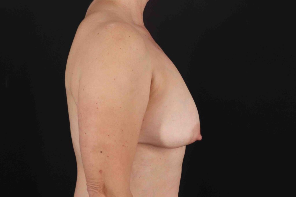 Before - right_lateral