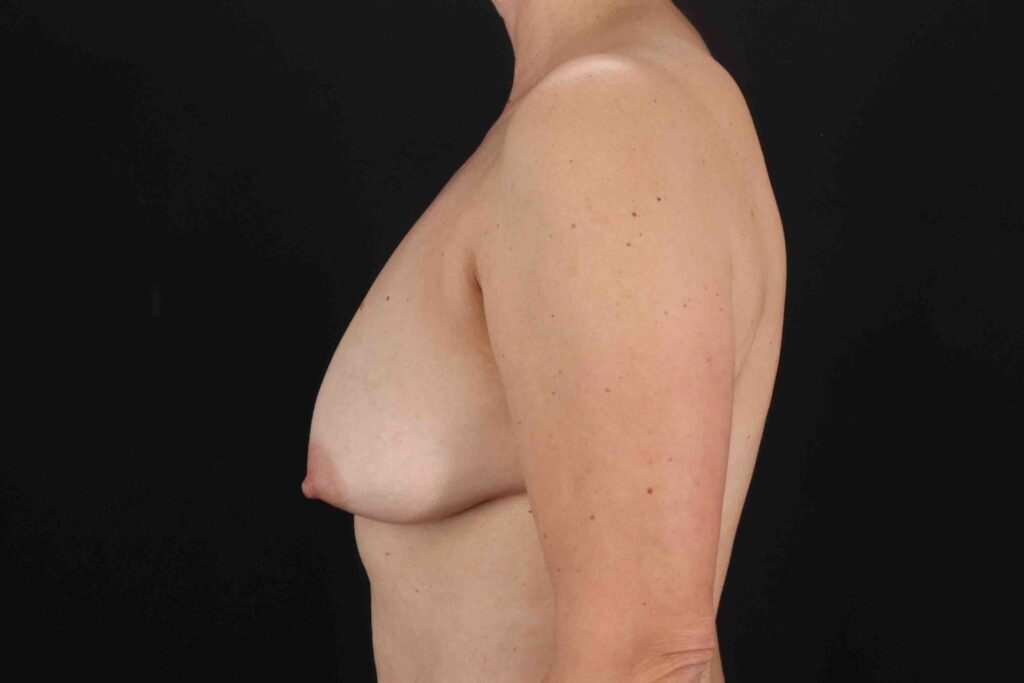 Before - left_lateral