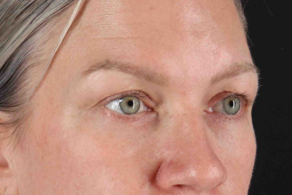 Before - right_oblique