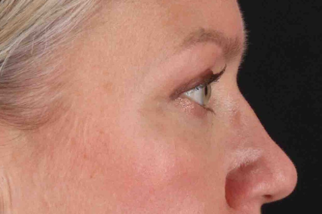 After - right_lateral