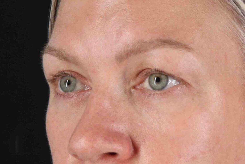 Before - left_oblique