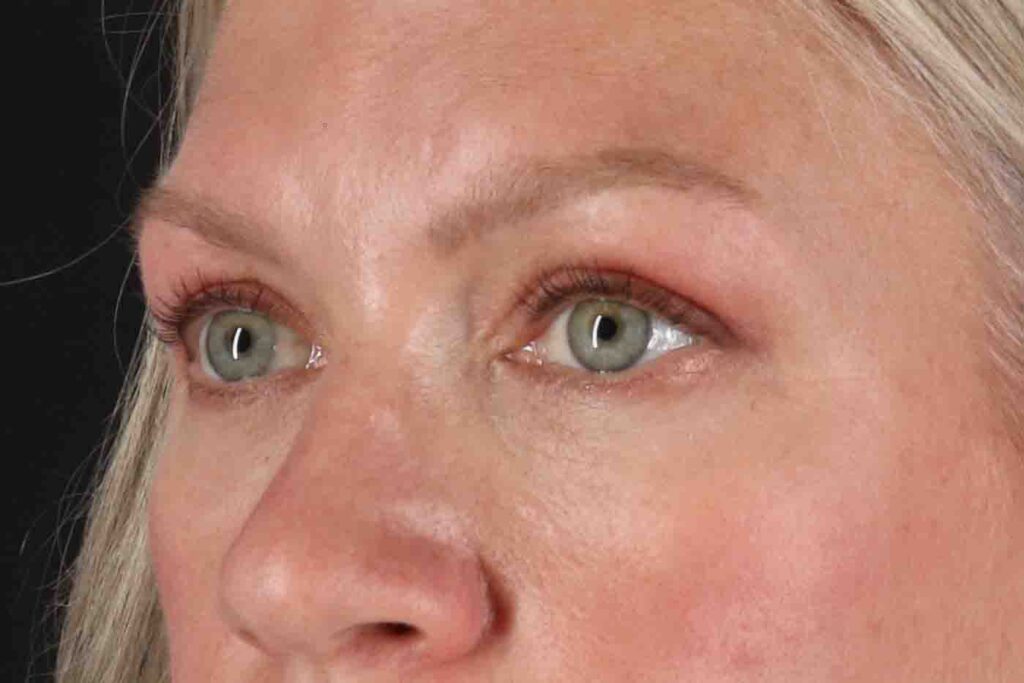 After - left_oblique