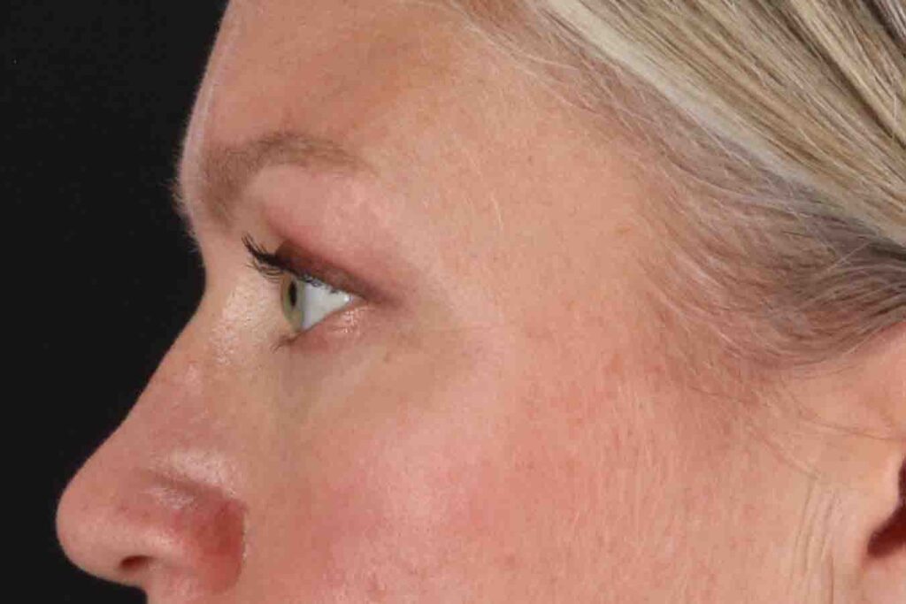 After - left_lateral