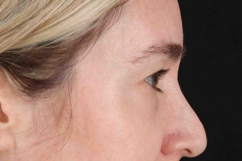 Before - right_lateral