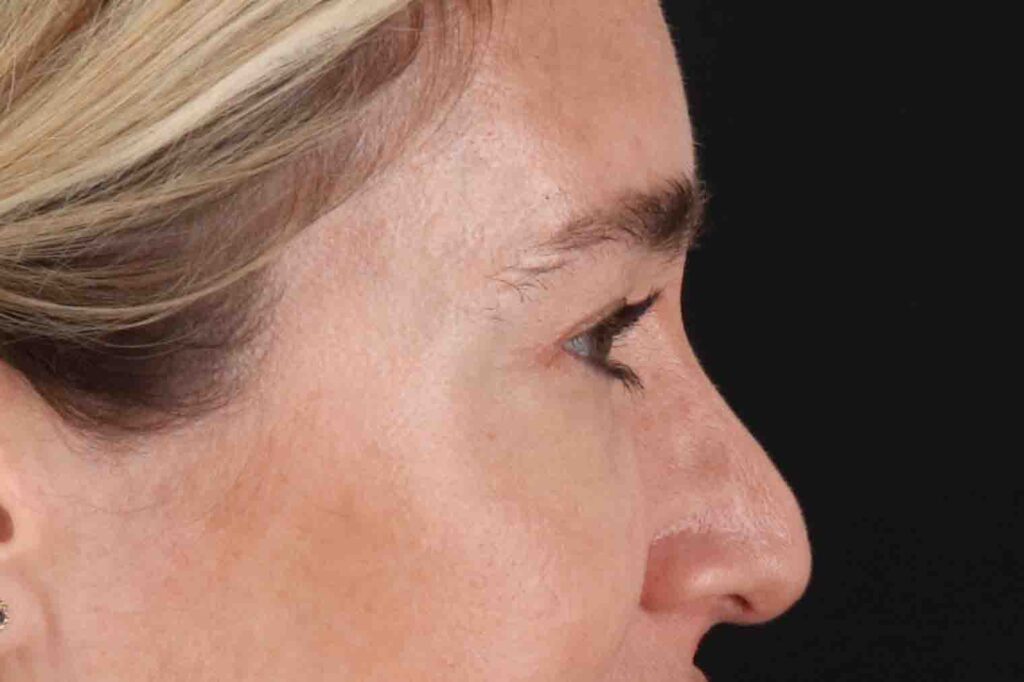 After - right_lateral