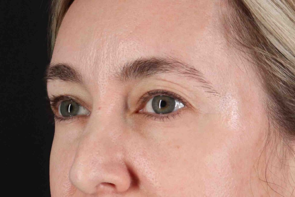 Before - left_oblique