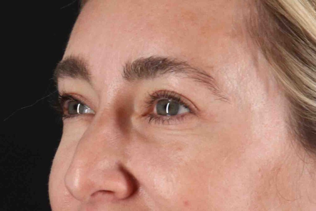 After - left_oblique