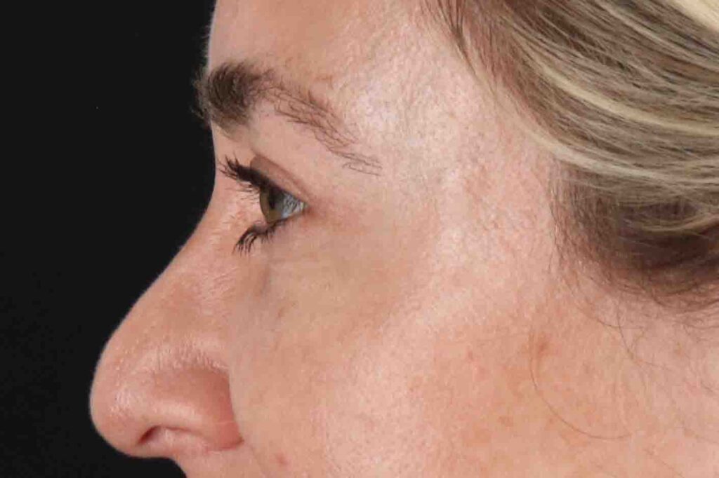 After - left_lateral