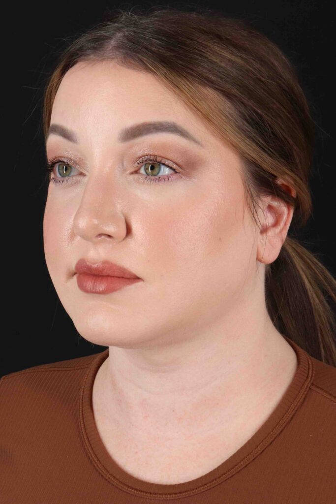 After - left_oblique