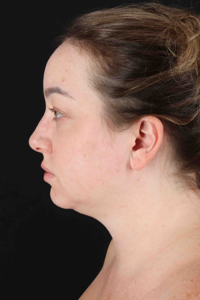 Before - left_lateral