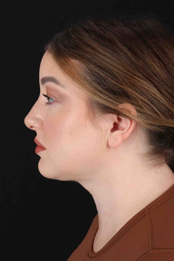 After - left_lateral