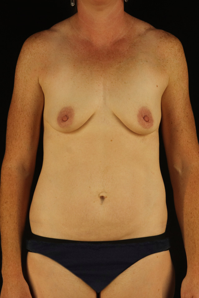 Before - 3393