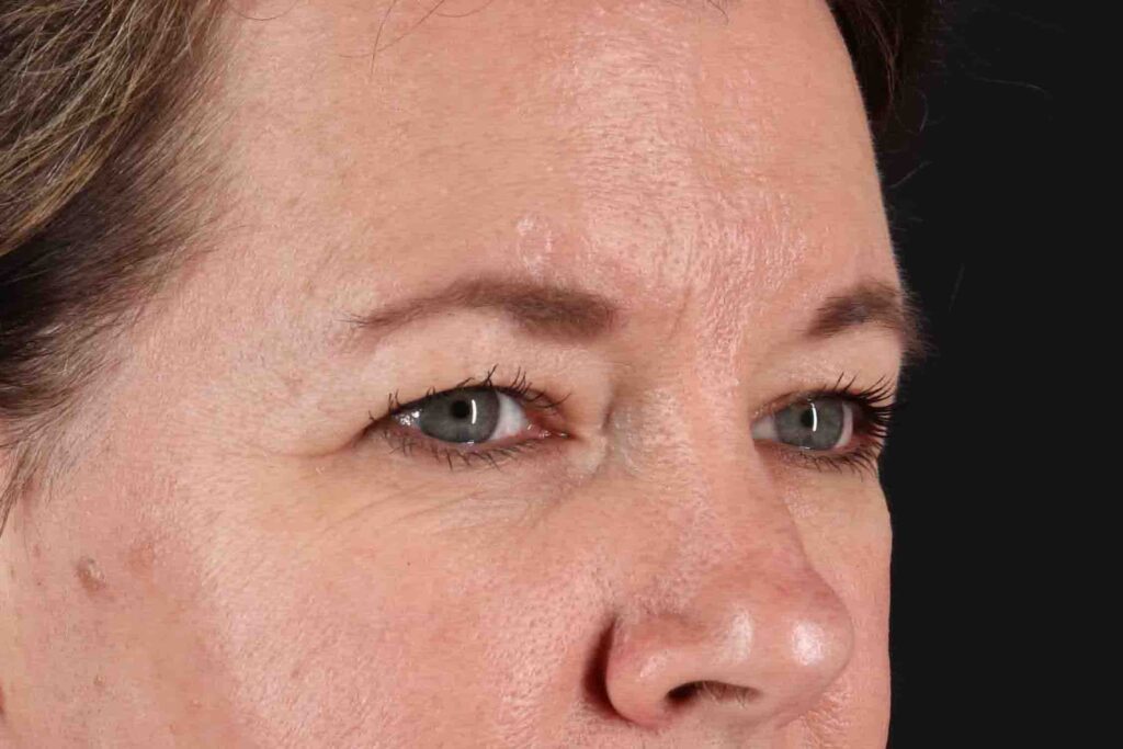 Before - right_oblique