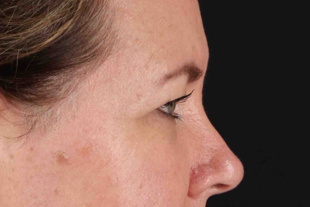 Before - right_lateral