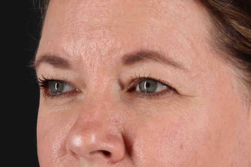 Before - left_oblique