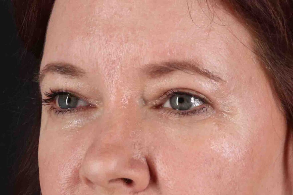 After - left_oblique