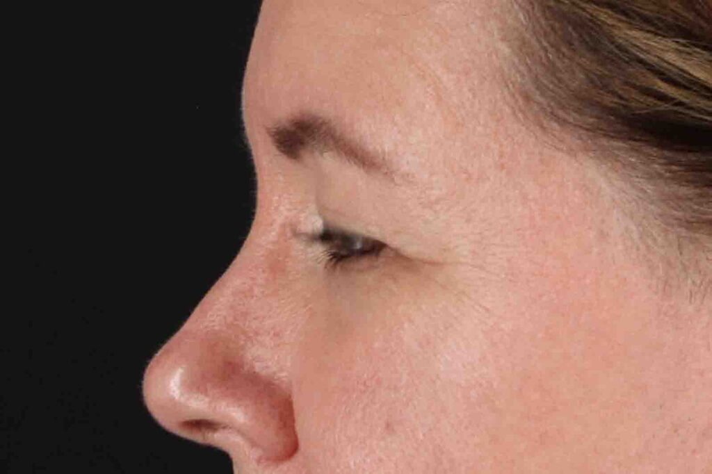 Before - left_lateral