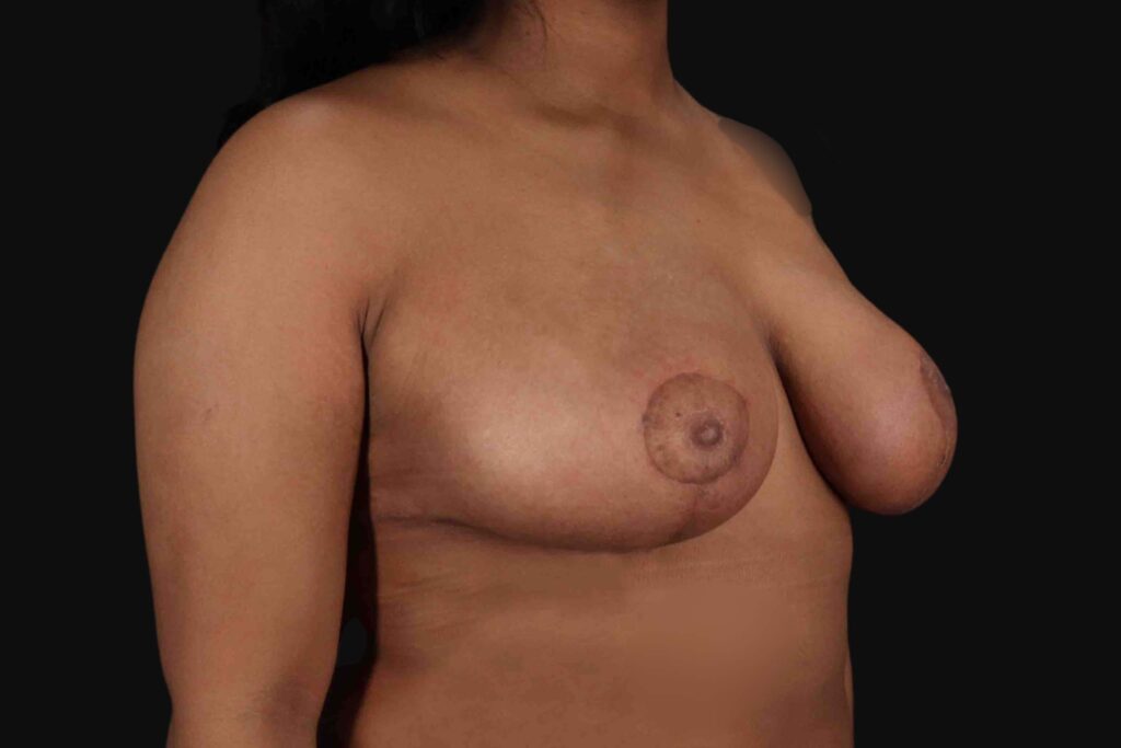 After - right_oblique