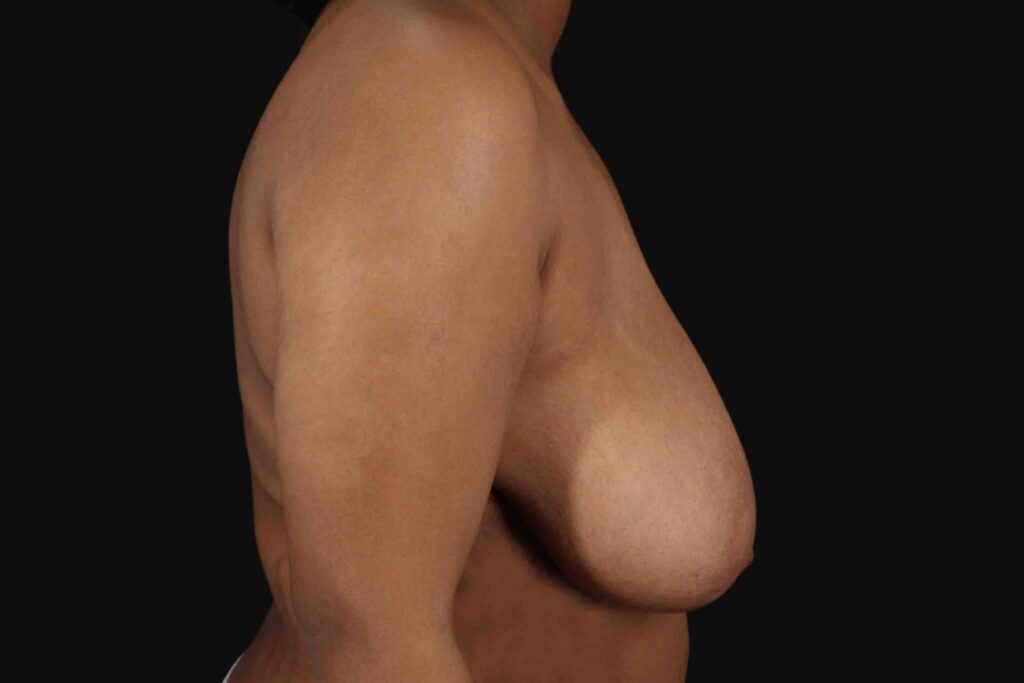 Before - right_lateral