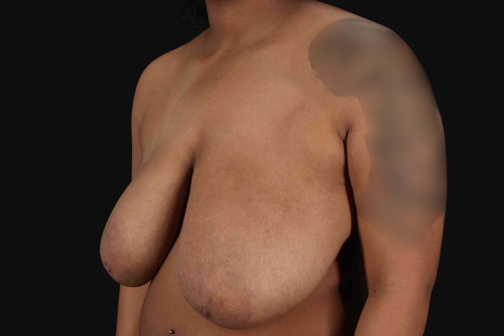 Before - left_oblique