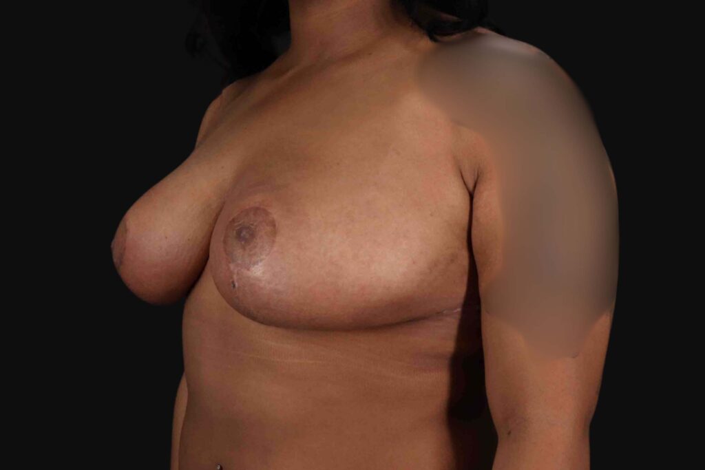 After - left_oblique