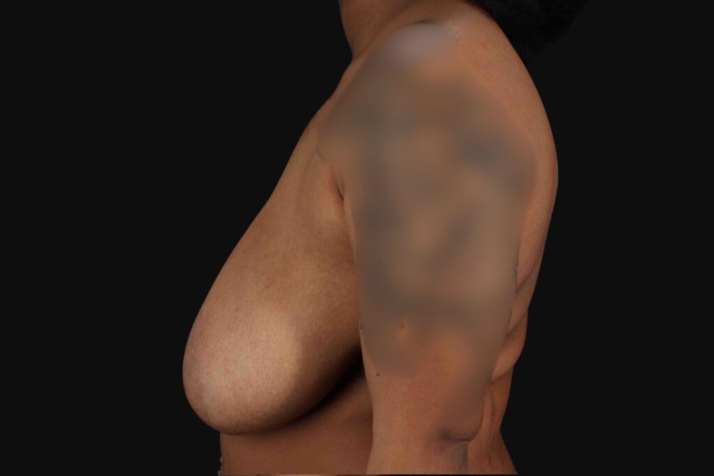 Before - left_lateral