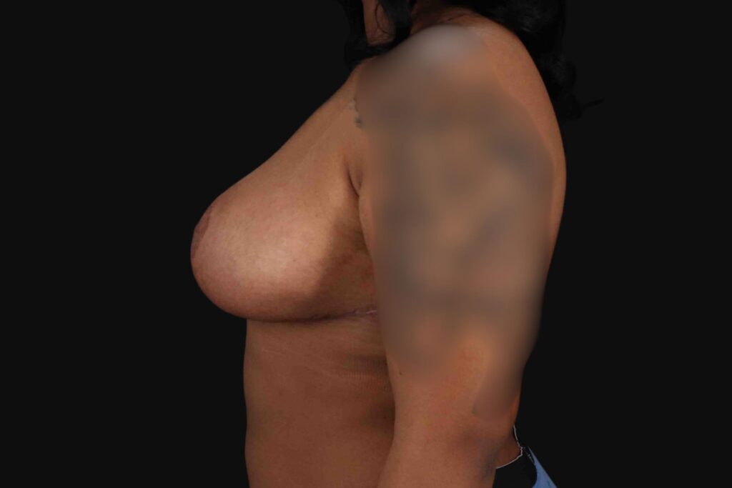 After - left_lateral