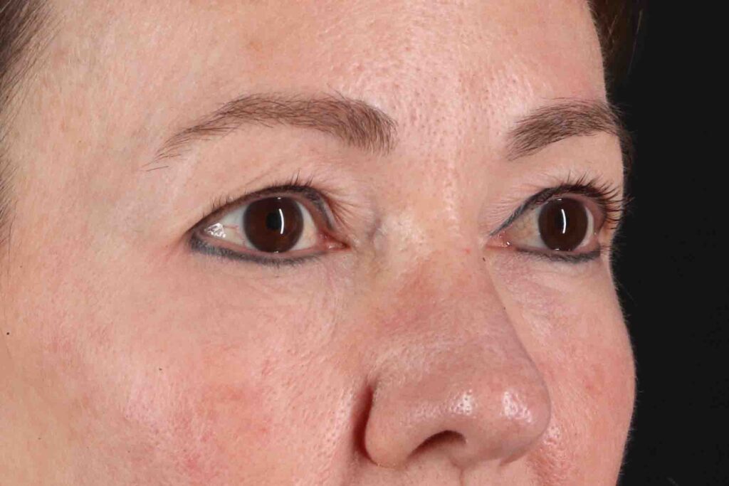 Before - right_oblique