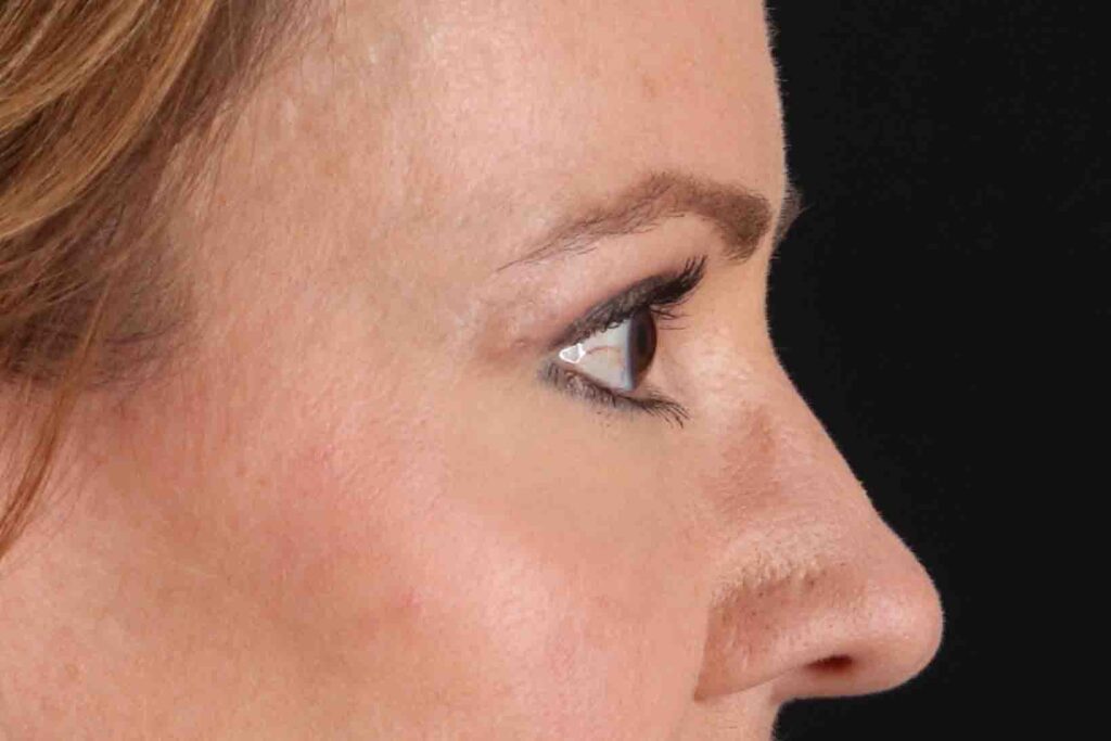 After - right_lateral