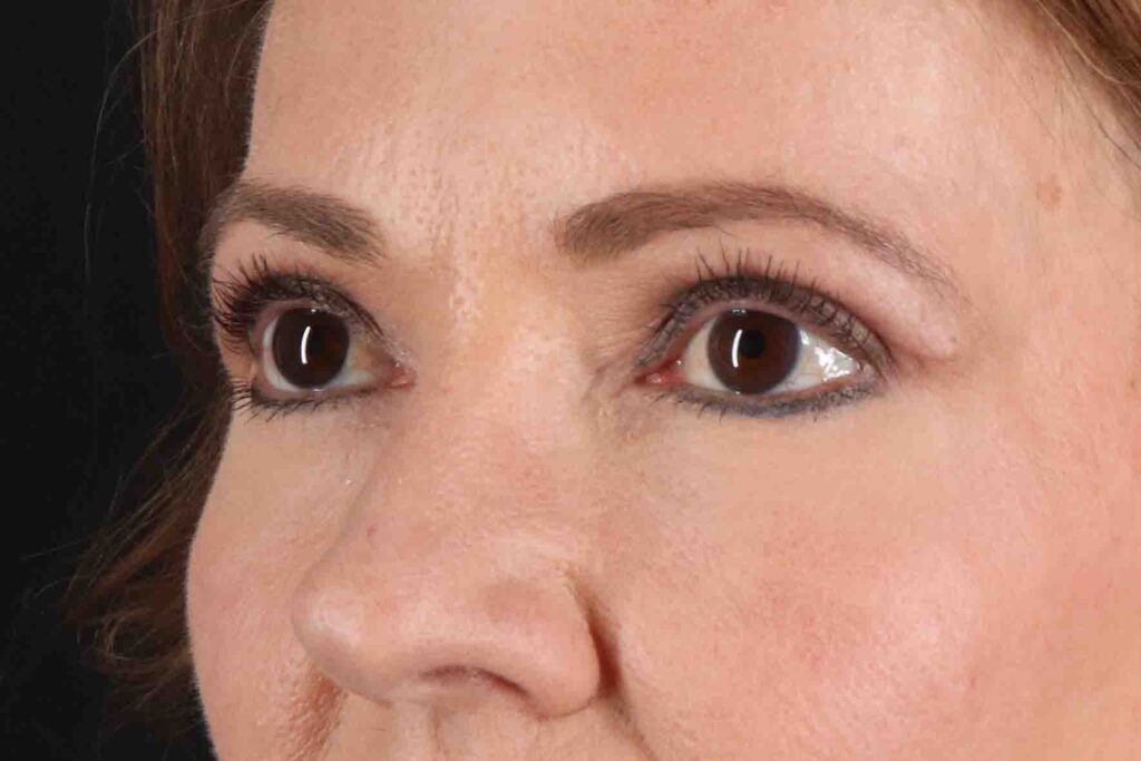 After - left_oblique