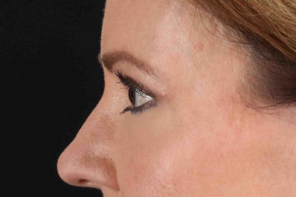 Before - left_lateral