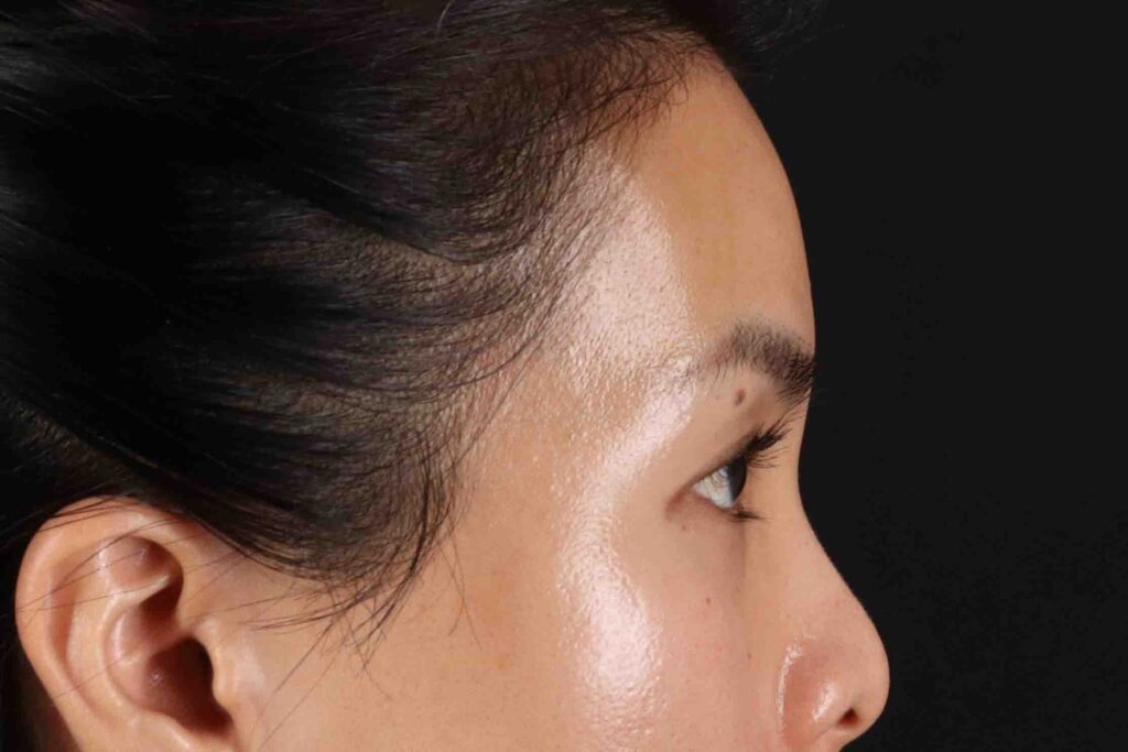 Before - right_lateral